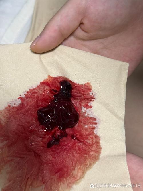 孕期反复出血，究竟是什么原因？-第3张图片-郑州医学网