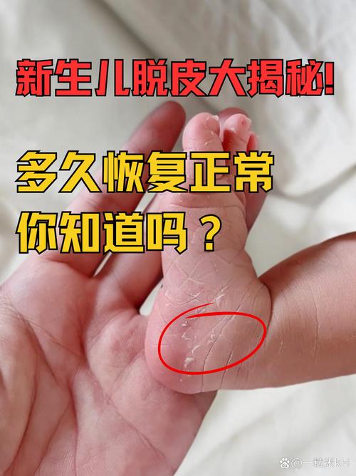 新生儿手脚脱皮是怎么回事-第2张图片-郑州医学网