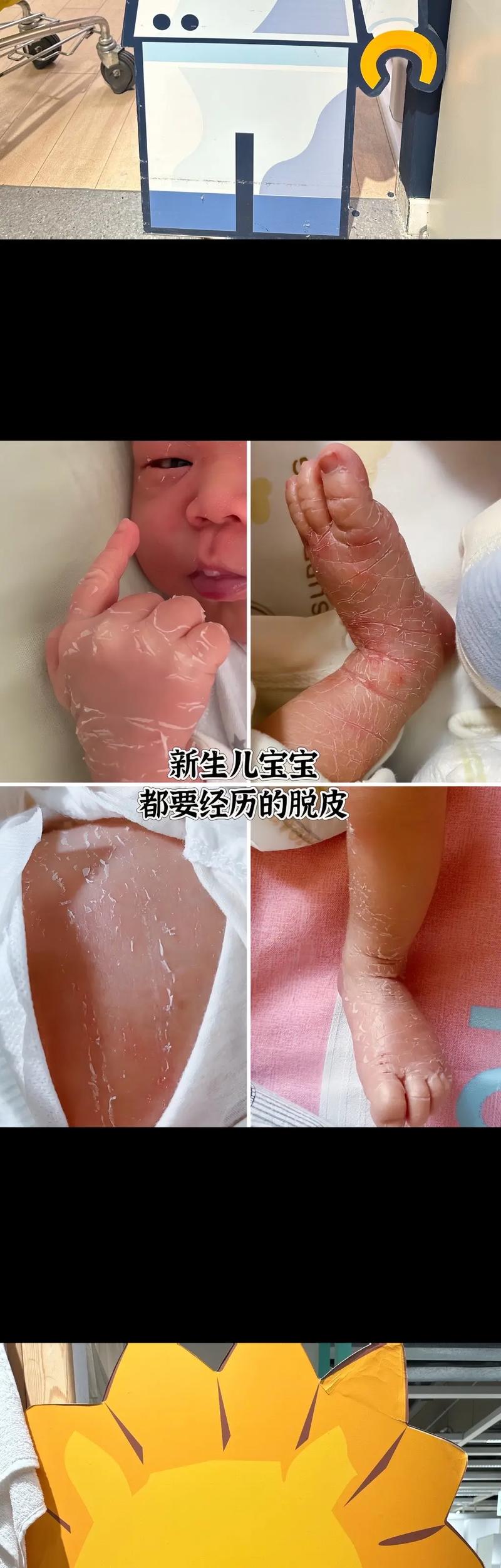 新生儿手脚脱皮是怎么回事-第1张图片-郑州医学网