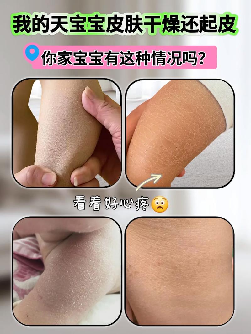 新生儿脱皮是正常现象吗?-第3张图片-郑州医学网 新生儿脱皮是正常现象吗?-第3张图片-郑州医学网