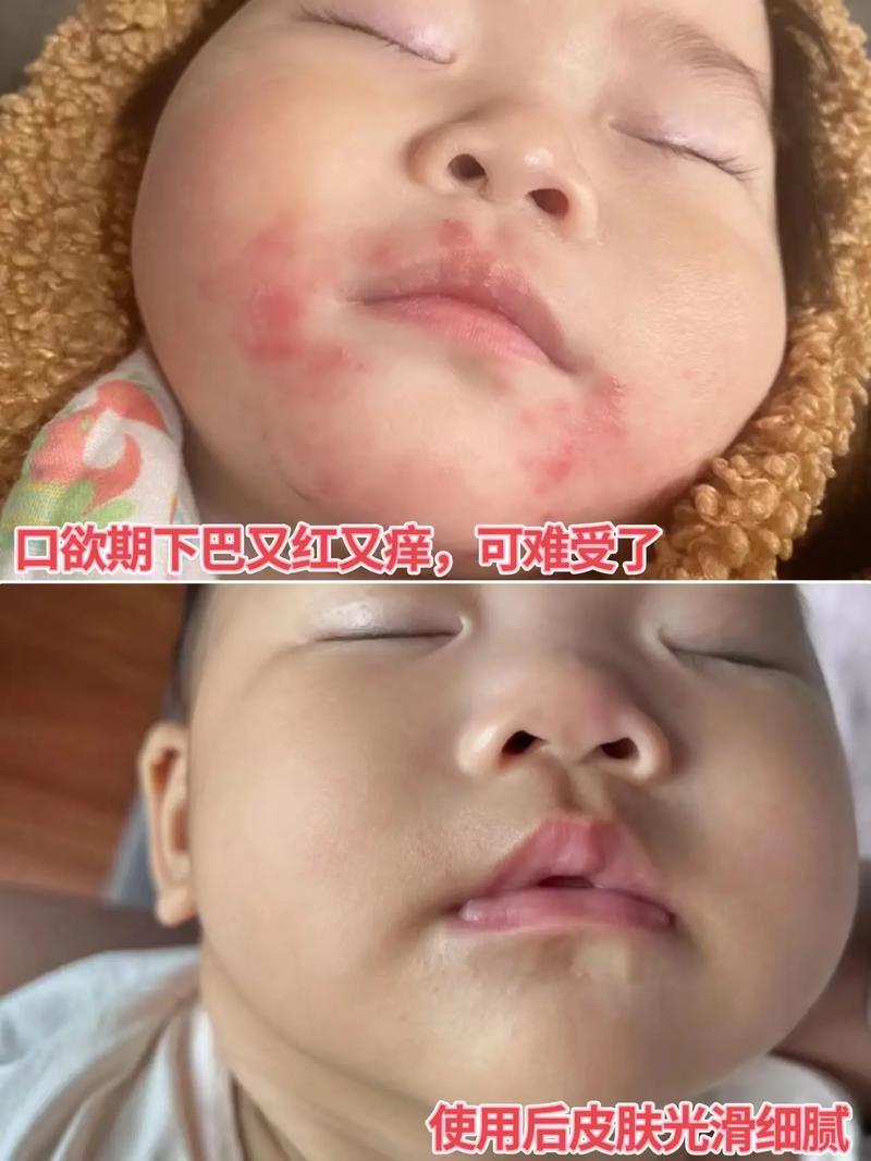 新生儿嘴周围发青怎么回事-第1张图片-郑州医学网