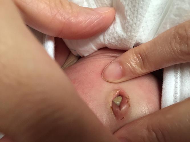 新生儿肚脐眼出血是何原因？-第2张图片-郑州医学网