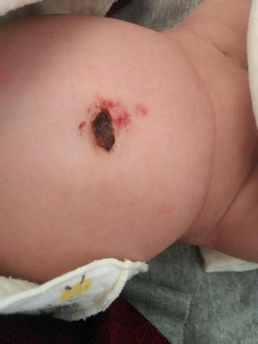 新生儿肚脐眼出血是何原因？-第3张图片-郑州医学网