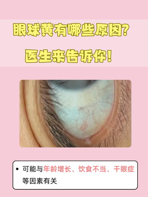 新生儿眼睛发黄是黄疸吗？-第3张图片-郑州医学网