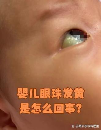 新生儿眼睛发黄是黄疸吗？-第1张图片-郑州医学网