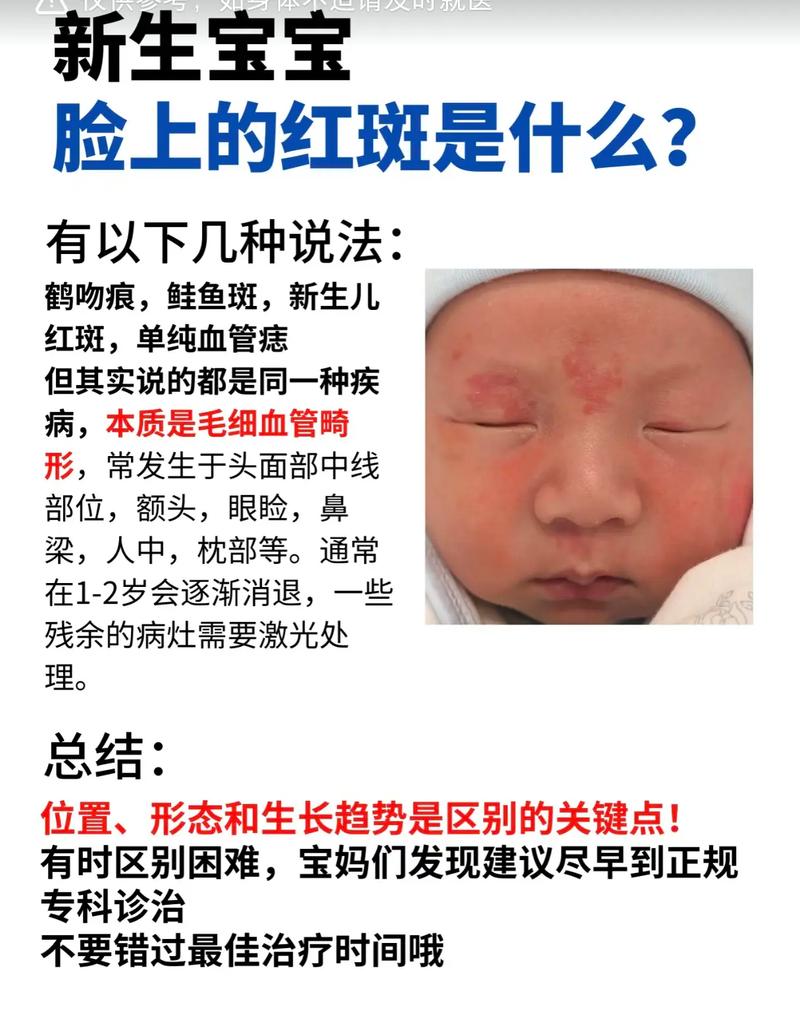 新生儿血管瘤最佳治疗时间-第1张图片-郑州医学网