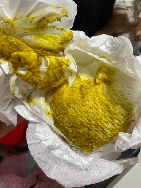 新生儿吃奶粉拉奶瓣正常吗？-第2张图片-郑州医学网