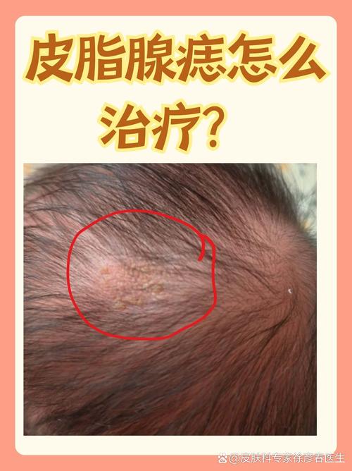 新生儿面部皮脂腺痣会自愈吗?-第1张图片-郑州医学网 新生儿面部皮脂腺痣会自愈吗?-第1张图片-郑州医学网