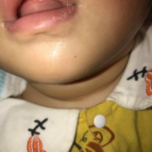 新生儿面部皮脂腺痣会自愈吗？-第2张图片-郑州医学网