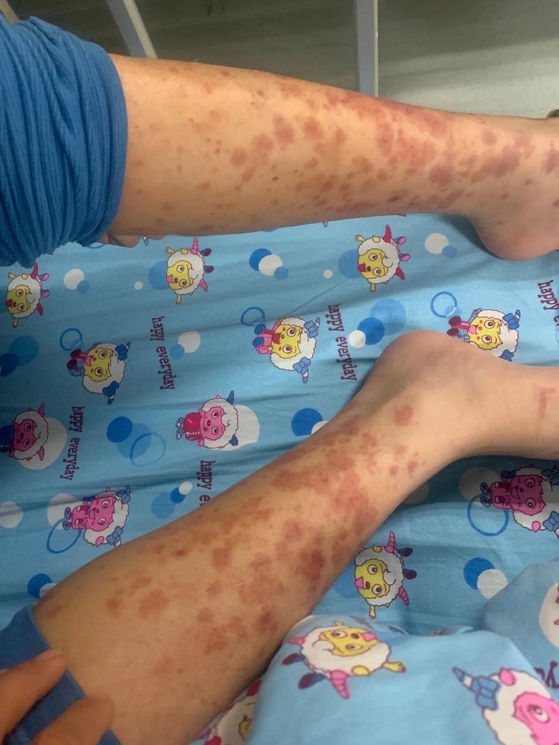 儿童过敏性紫癜会复发吗？-第3张图片-郑州医学网