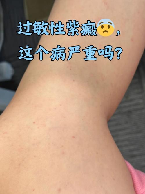 儿童过敏性紫癜会复发吗？-第1张图片-郑州医学网