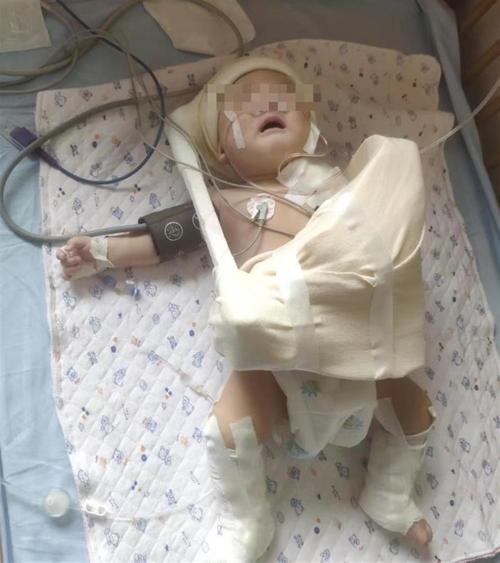 新生儿臂丛神经损伤如何有效治疗?-第2张图片-郑州医学网 新生儿臂丛神经损伤如何有效治疗?-第2张图片-郑州医学网