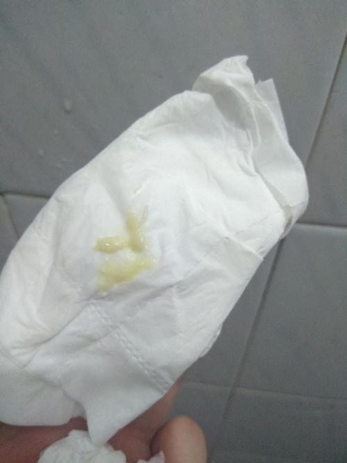 孕期白带黄绿色有异味怎么办？-第3张图片-郑州医学网