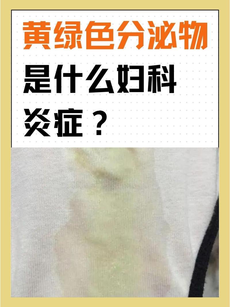 孕期白带黄绿色有异味怎么办？-第2张图片-郑州医学网