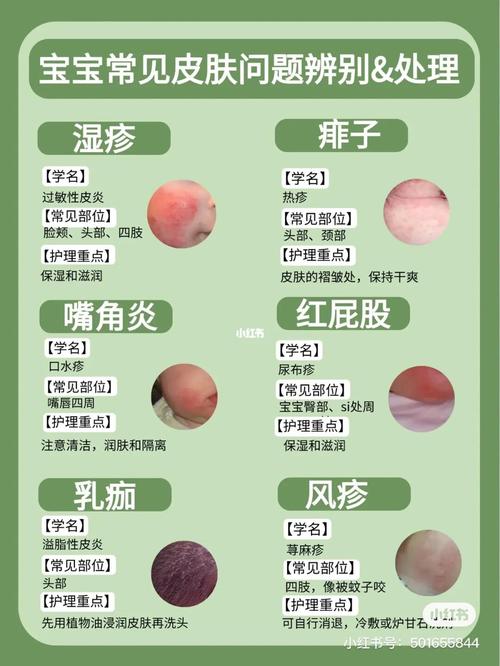 儿童过敏性湿疹怎么治?-第3张图片-郑州医学网 儿童过敏性湿疹怎么治?-第3张图片-郑州医学网