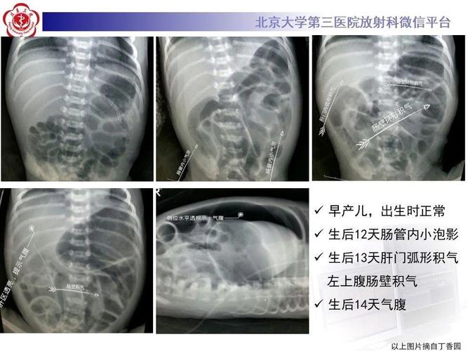 新生儿急性坏死性小肠炎有何致命风险?-第1张图片-郑州医学网 新生儿急性坏死性小肠炎有何致命风险?-第1张图片-郑州医学网