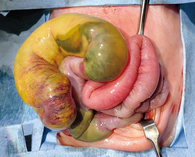 新生儿急性坏死性小肠炎有何致命风险？-第3张图片-郑州医学网