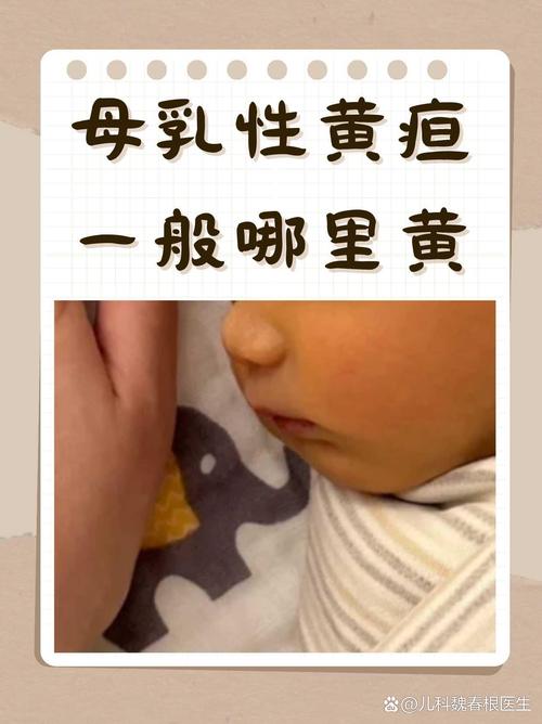 新生儿黄疸能喂母乳吗？-第1张图片-郑州医学网