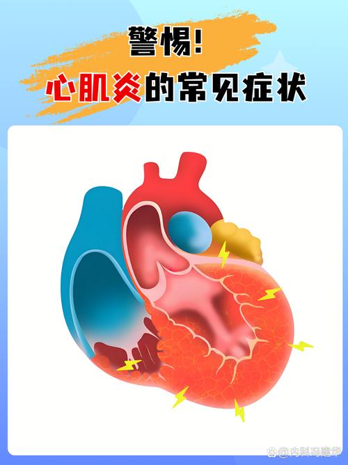 孕期心肌炎有哪些典型症状？-第3张图片-郑州医学网