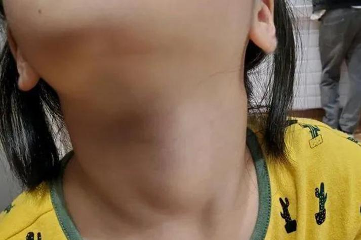 儿童甲减症状有哪些?早识别早治疗很重要-第2张图片-郑州医学网 儿童甲减症状有哪些?早识别早治疗很重要-第2张图片-郑州医学网