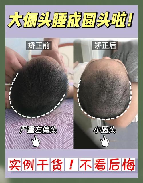 孕期头偏大怎么办？需要干预吗？-第3张图片-郑州医学网