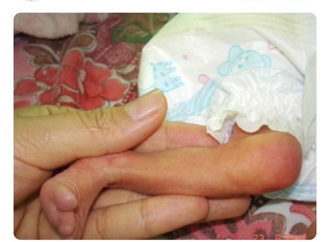 新生儿硬肿症有哪些临床特征？-第2张图片-郑州医学网