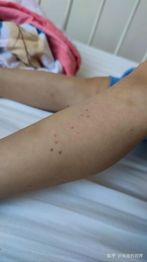 儿童过敏性紫癜能自愈吗？-第2张图片-郑州医学网