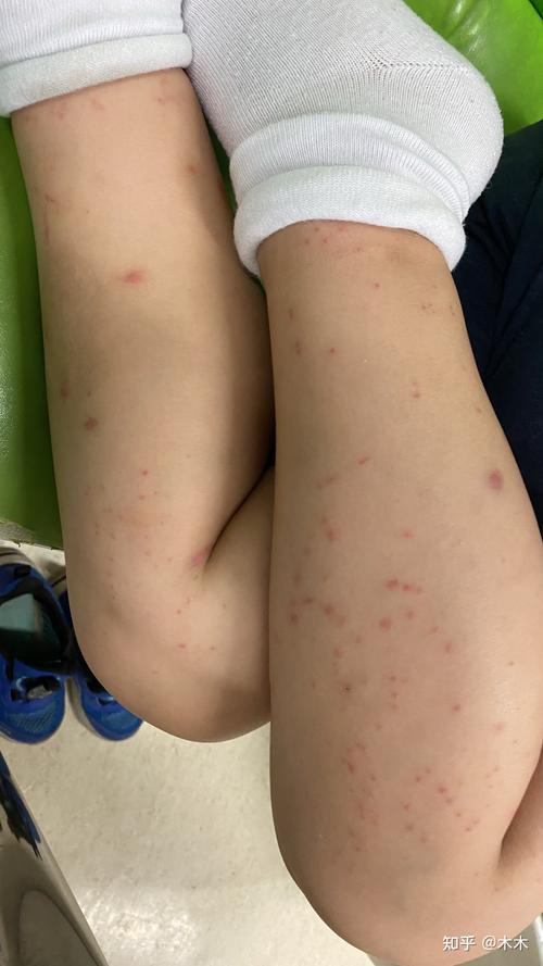 儿童过敏性紫癜能自愈吗？-第1张图片-郑州医学网