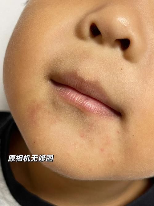 儿童过敏性皮炎症状图片有哪些表现？-第2张图片-郑州医学网