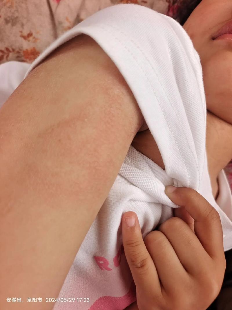 儿童过敏性皮炎症状图片有哪些表现？-第3张图片-郑州医学网