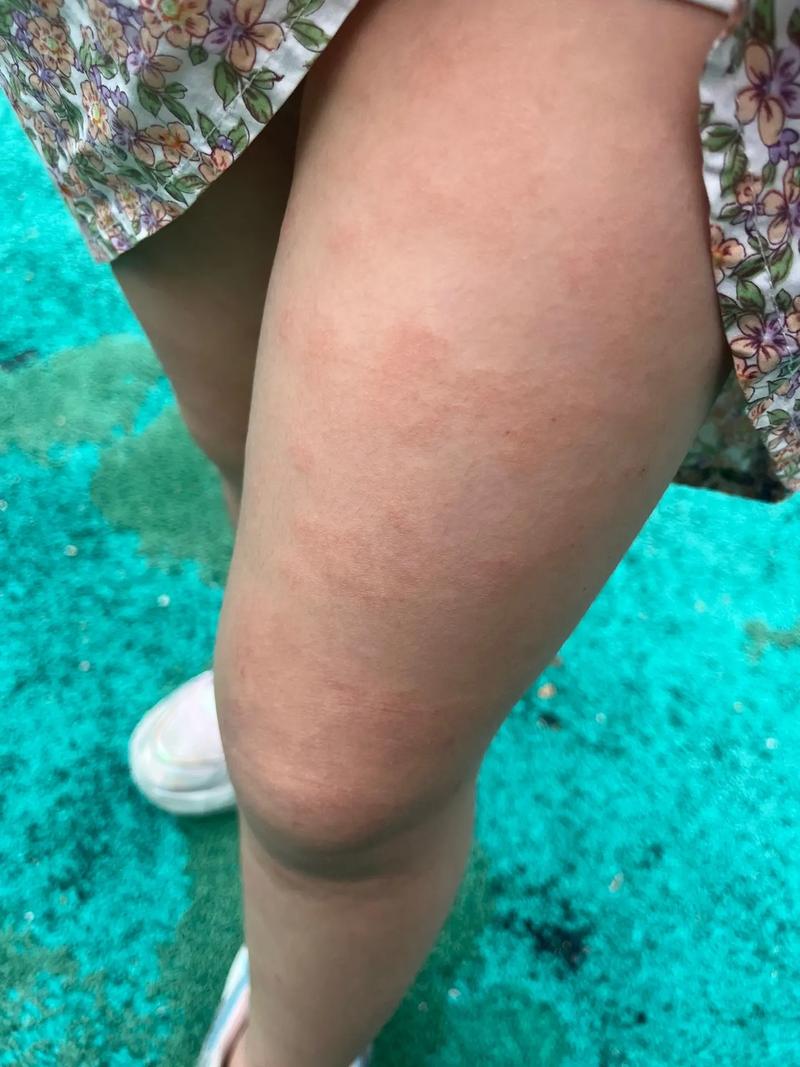 儿童过敏性皮炎症状图片有哪些表现？-第1张图片-郑州医学网