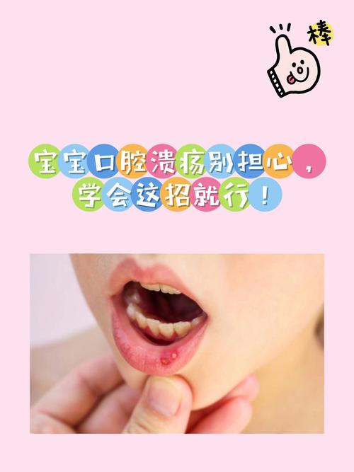 3岁宝宝口腔溃疡怎么办?-第3张图片-郑州医学网 3岁宝宝口腔溃疡怎么办?-第3张图片-郑州医学网