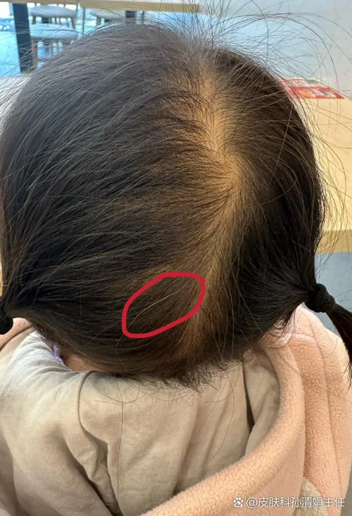 儿童白发是缺营养还是生病了？-第3张图片-郑州医学网