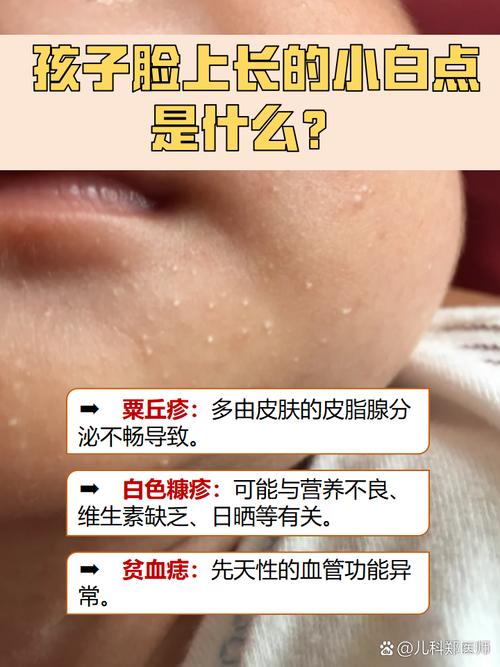 新生儿白点是啥原因?-第3张图片-郑州医学网 新生儿白点是啥原因?-第3张图片-郑州医学网