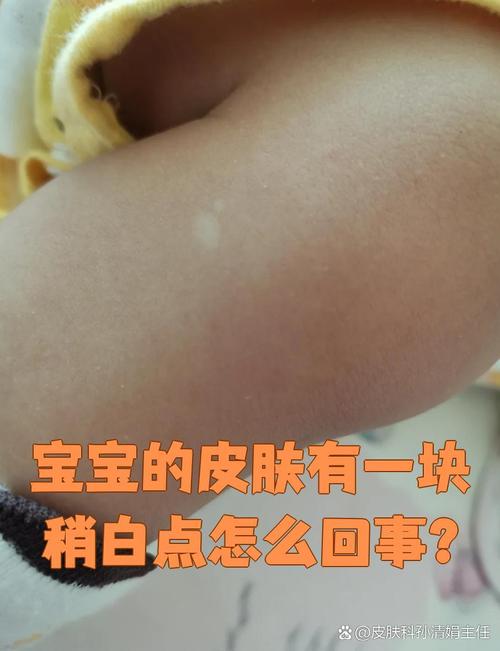 新生儿白点是啥原因?-第2张图片-郑州医学网 新生儿白点是啥原因?-第2张图片-郑州医学网