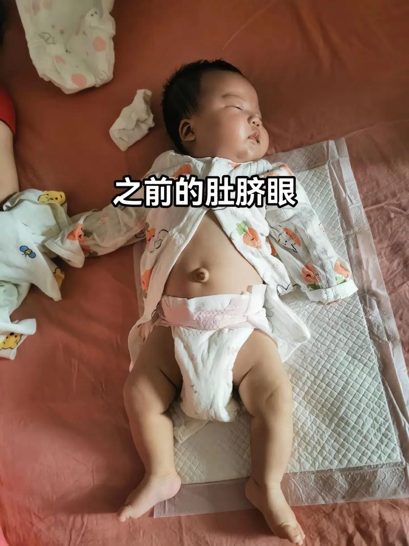 新生儿肚脐高是什么原因？-第2张图片-郑州医学网