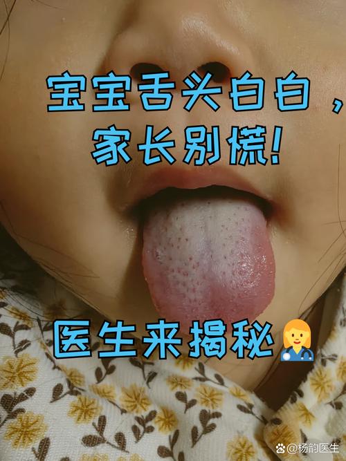 新生儿舌苔发白是正常现象还是健康预警？需要处理吗？-第2张图片-郑州医学网