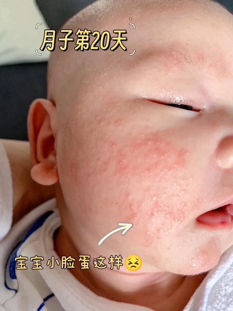新生儿脸上起红点别慌！是湿疹、热疹还是过敏？正确处理与护理指南-第1张图片-郑州医学网