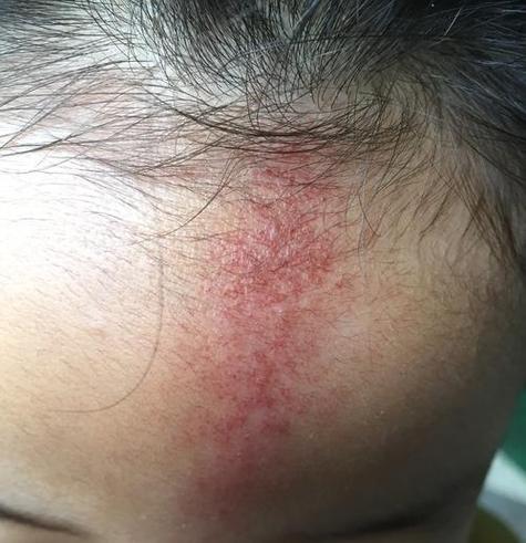 新生儿脸上头上有小红点是湿疹还是痱子？需要治疗吗？-第1张图片-郑州医学网