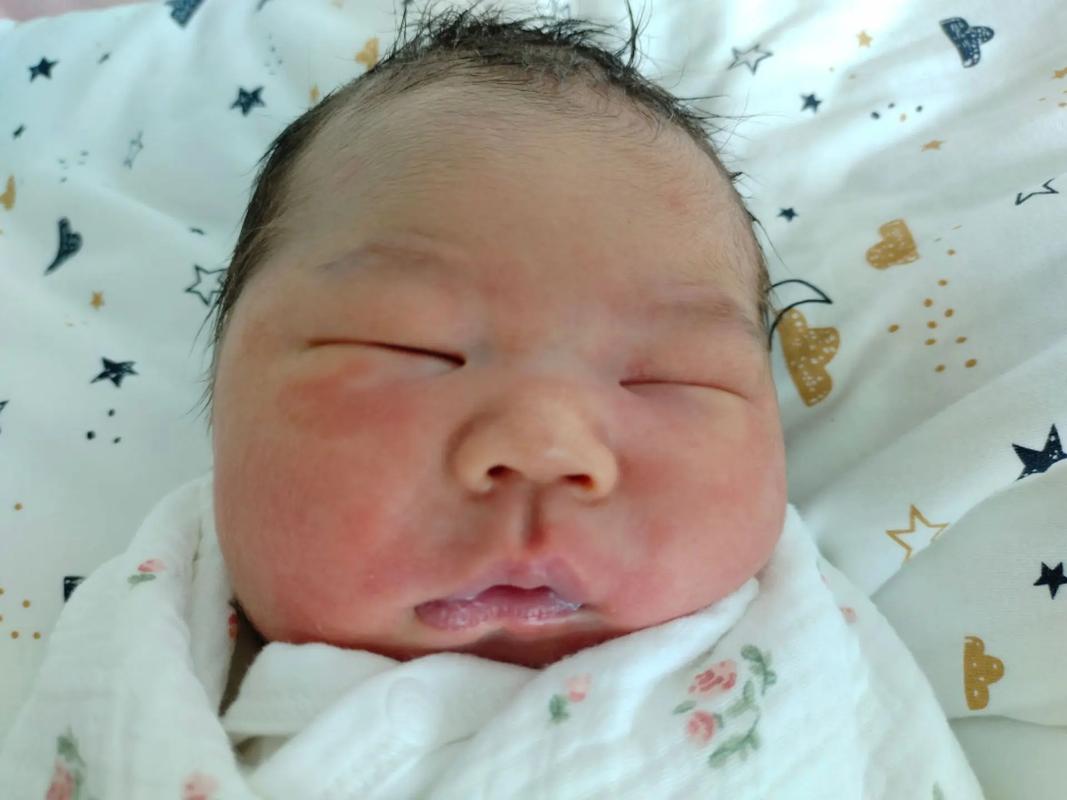 新生儿脸上头上有小红点是湿疹还是痱子？需要治疗吗？-第2张图片-郑州医学网