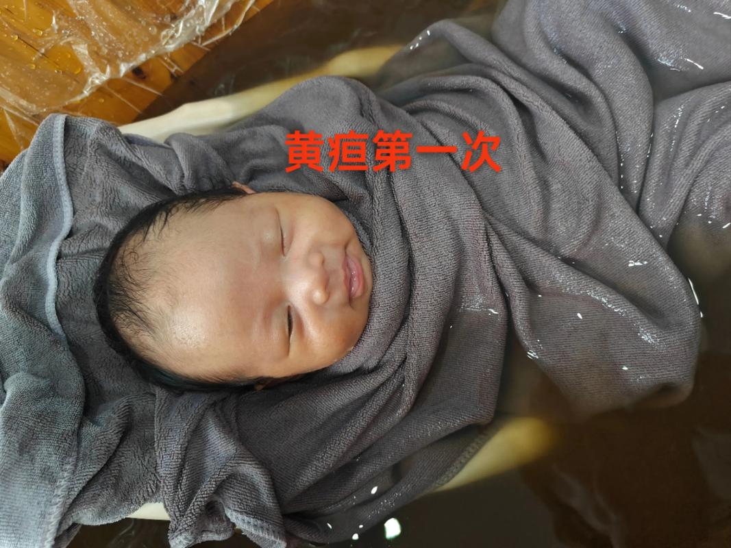 新生儿第四天黄疸240高吗？需要照蓝光治疗吗？对大脑有影响吗？-第3张图片-郑州医学网