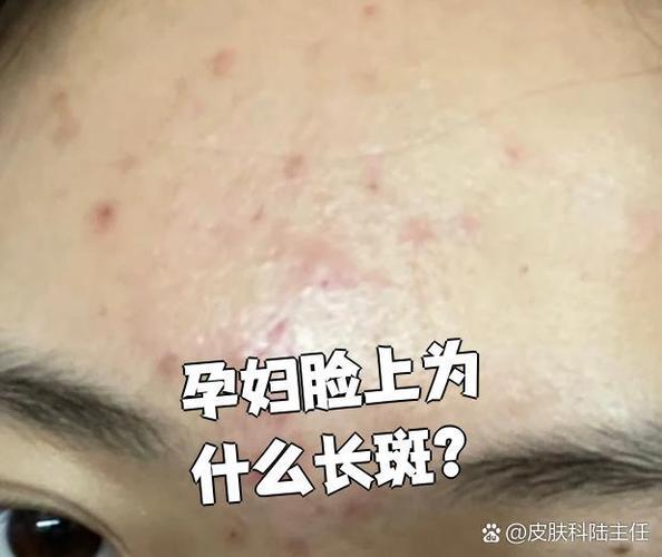 怀孕期间怎样不长斑点？有哪些科学方法能预防孕期色斑形成？-第2张图片-郑州医学网