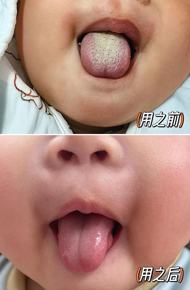 新生儿舌头发黑是正常现象还是疾病信号？需警惕哪些潜在原因？-第1张图片-郑州医学网