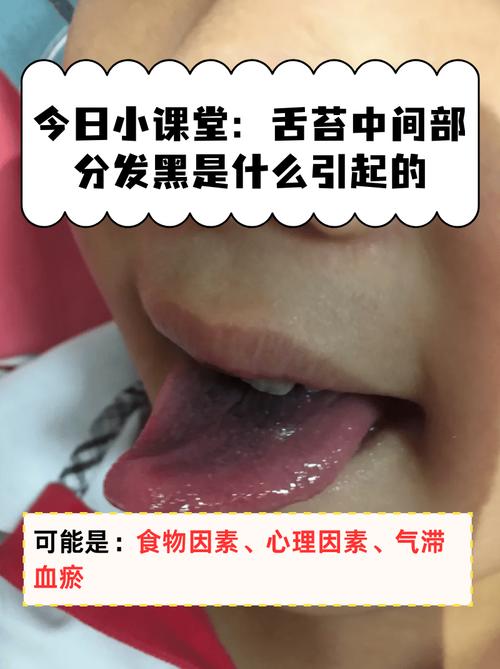 新生儿舌头发黑是正常现象还是疾病信号？需警惕哪些潜在原因？-第3张图片-郑州医学网