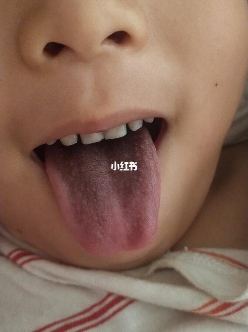 新生儿舌头发黑是正常现象还是疾病信号？需警惕哪些潜在原因？-第2张图片-郑州医学网