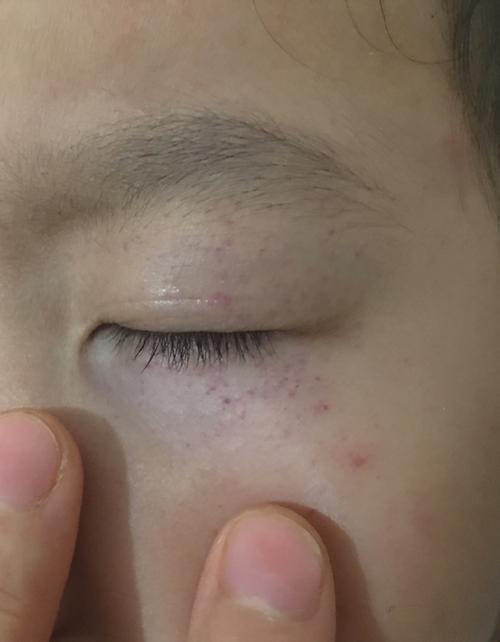 新生儿眼睛周围小红点是正常现象还是疾病信号？需要干预吗？-第1张图片-郑州医学网