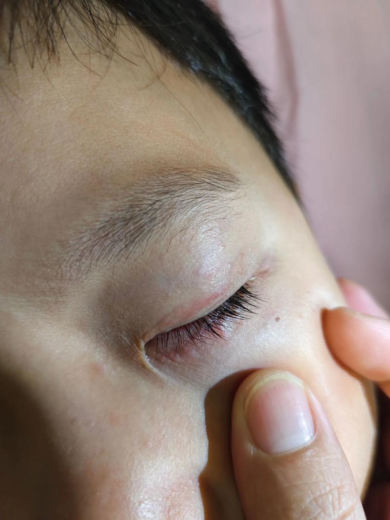 新生儿眼睛周围小红点是正常现象还是疾病信号？需要干预吗？-第3张图片-郑州医学网