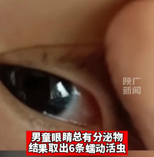 新生儿眼角白色分泌物是正常现象还是眼部疾病的信号？-第1张图片-郑州医学网