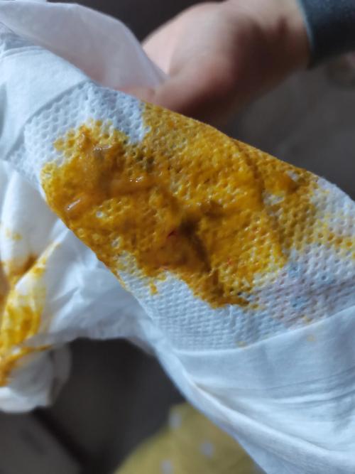 20天新生儿大便有血丝是正常现象还是疾病信号？该如何应对？-第2张图片-郑州医学网