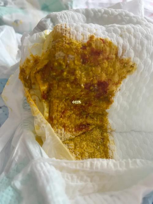 20天新生儿大便有血丝是正常现象还是疾病信号？该如何应对？-第3张图片-郑州医学网